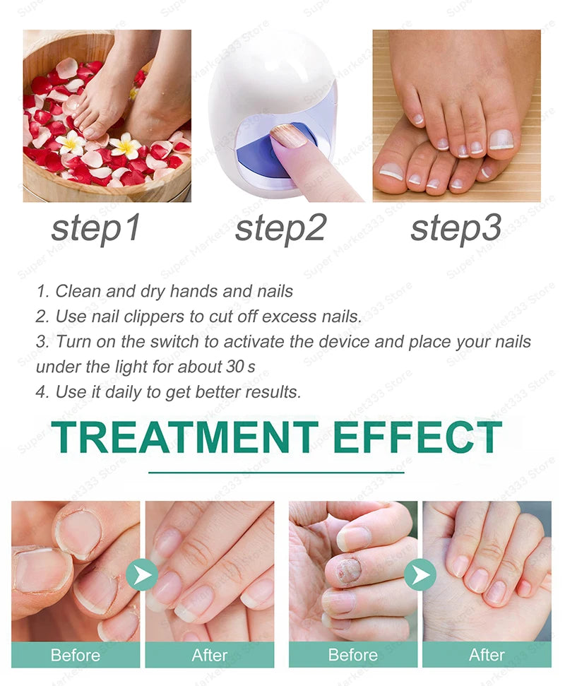 Laser Nail Therapy Device – Effective Solution for Nail Problems