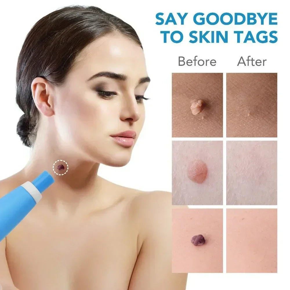 2-in-1 Acne & Skin Tag Remover Device – Mole, Wart & Blemish Removal Kit