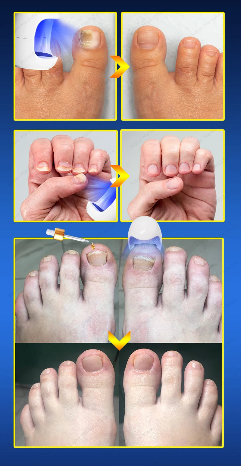 Laser Nail Therapy Device – Effective Solution for Nail Problems