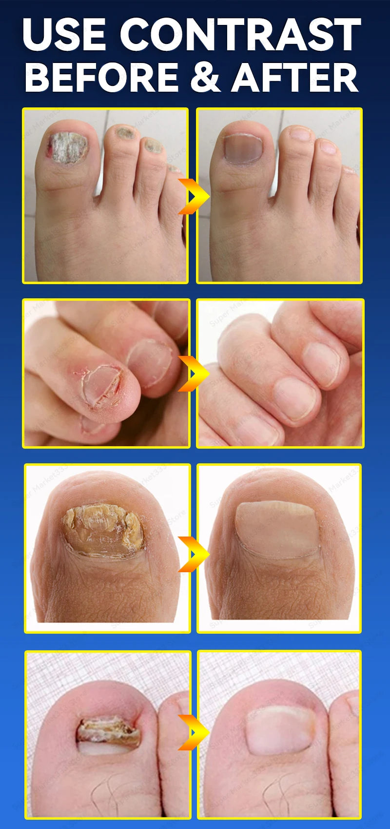 Laser Nail Therapy Device – Effective Solution for Nail Problems